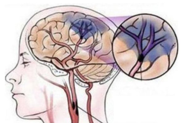 Ischemic damage to the brain due to blocked blood vessels