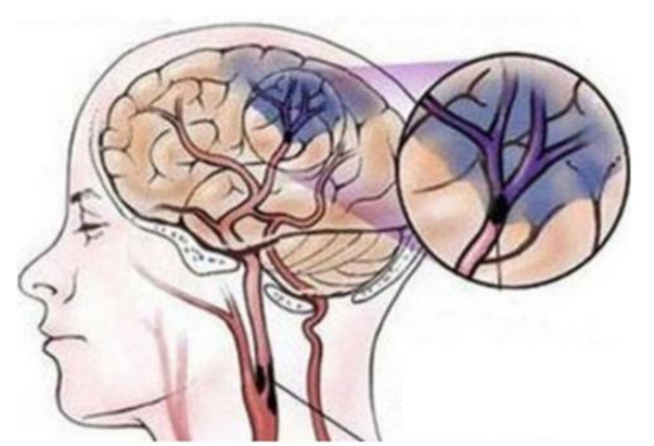 Ischemic damage to the brain due to blocked blood vessels